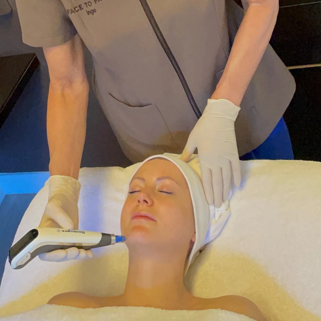 Microneedlingbehandeling met de Dermapen 4 bij Face to Face